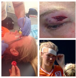 A cheeky 5 stitches #headache (Kim Carroll Instagram)