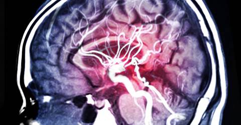 Fujitsu leads push to detect brain aneurysms with AI