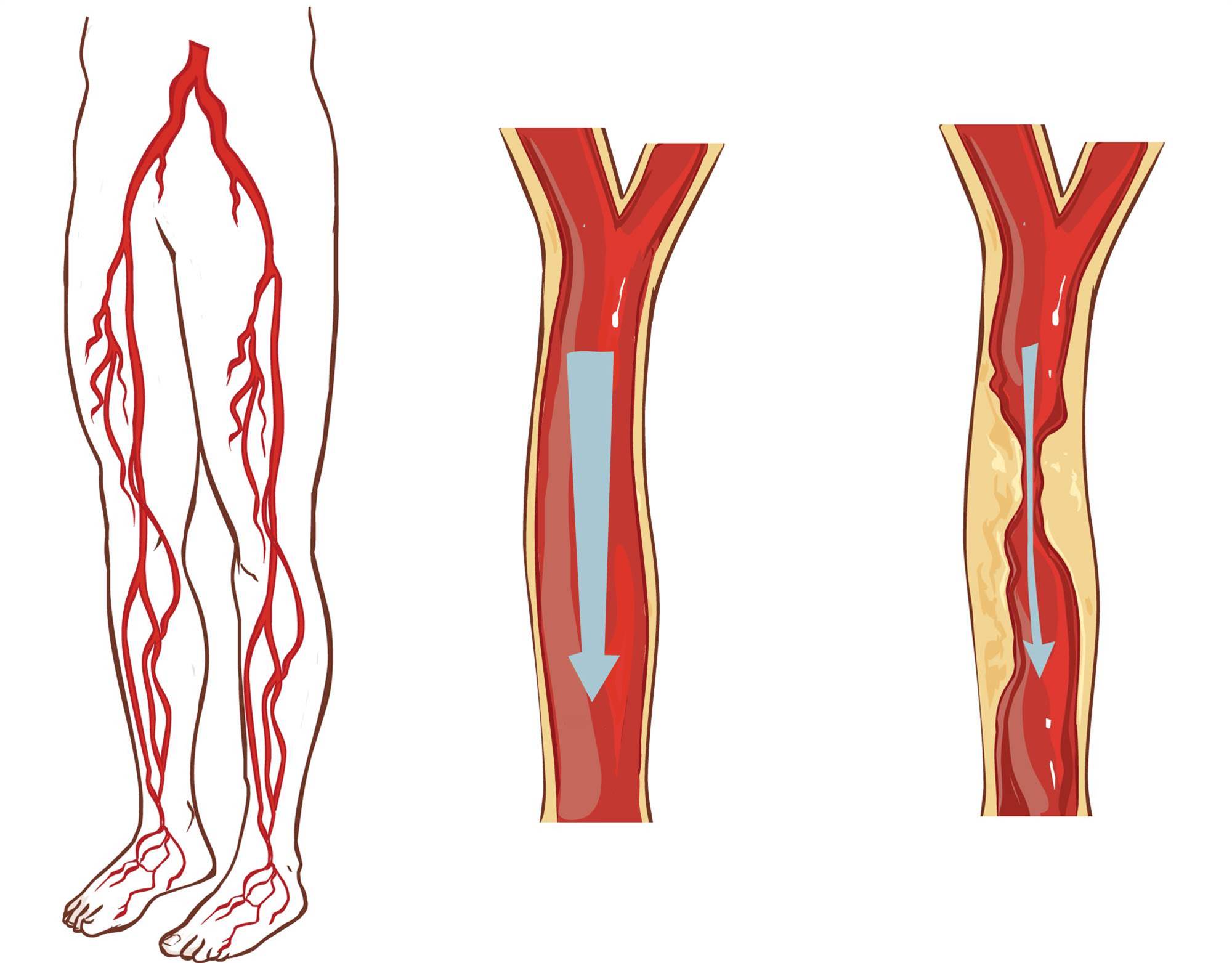Тромбоз артерии лечение. Облитерирующий атеросклероз сосудов. Облитерирующий атеросклероз вен нижних конечностей. Облитерирующий атеросклероз (ОАСНК). Облитерирующий атеросклероз голени.