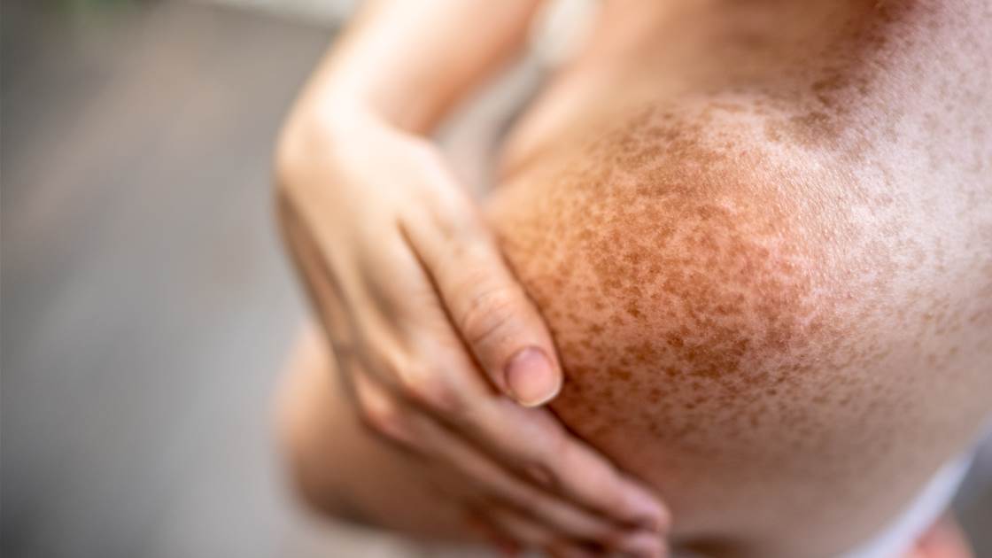 Close-up of freckles on a person’s shoulder, showcasing natural skin pigmentation. Close-up of freckles on a person’s shoulder, showcasing natural skin pigmentation.