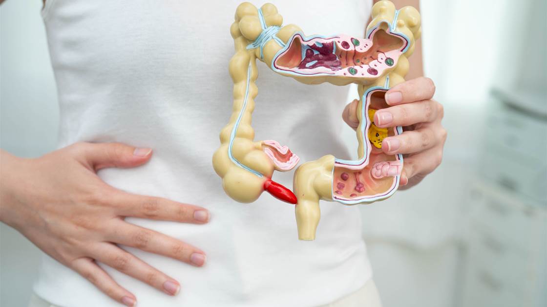 Model of digestive tract showing Crohn’s disease inflammation Model of digestive tract showing Crohn’s disease inflammation