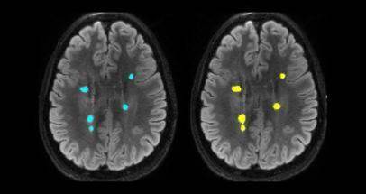 Sydney brain scanners speed up analysis with AI