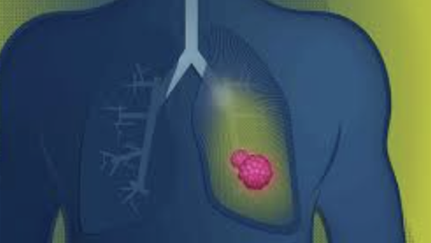 Malaysia's IKN to introduce AI-based tool to diagnose lung cancer