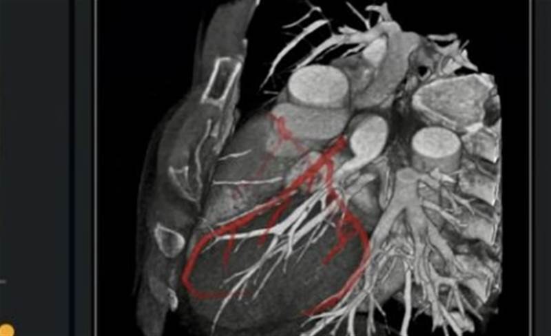 Singapore to pilot AI software for accurate CT scan interpretations