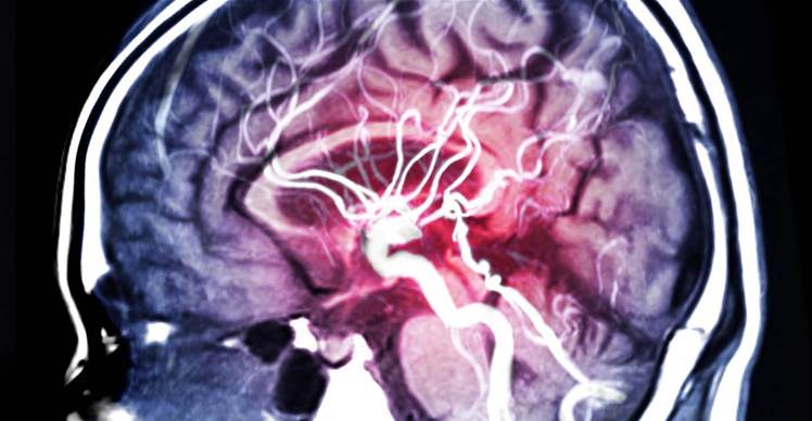Fujitsu leads push to detect brain aneurysms with AI