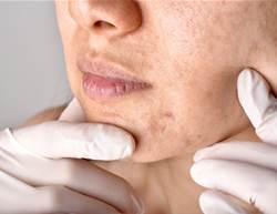 How to Fade Dark Spots Without Damaging Your Skin Barrier