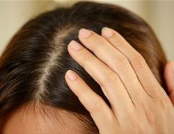 Stop Scalp Acne Before It Starts—Here’s How