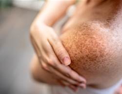 Freckles Decoded: The Science Behind Your Spots