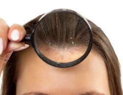 Dandruff or Dryness? How to Spot the Difference and Soothe Your Scalp