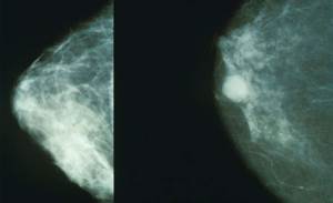 Google system could improve breast cancer detection