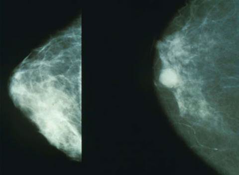 Google system could improve breast cancer detection