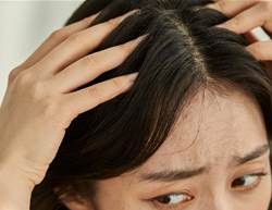 Is It Dandruff or Dry Scalp?