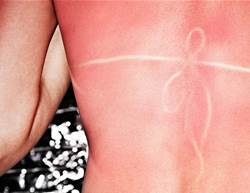 7 signs you have sun poisoning