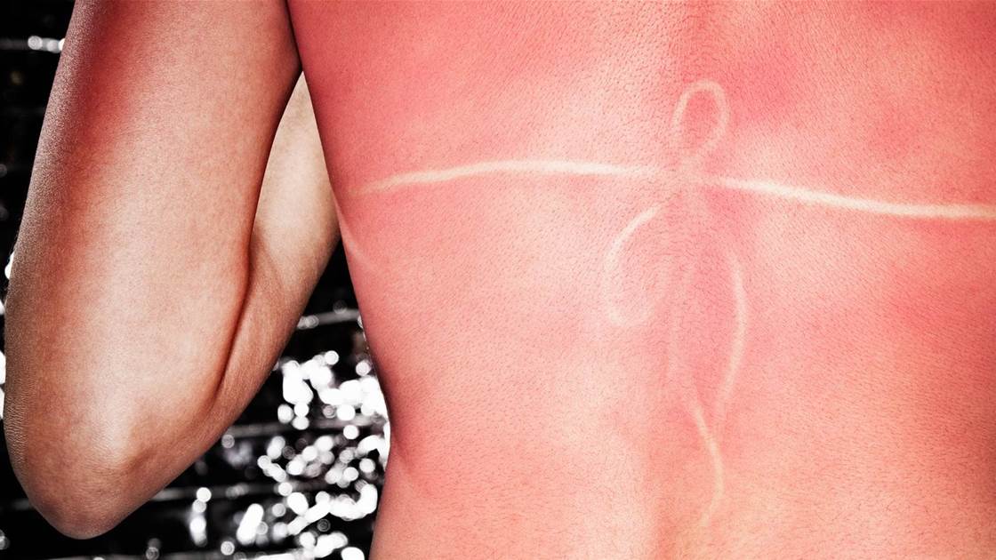 7 signs you have sun poisoning